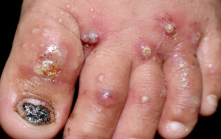 Lesioni cutanee malattia acaro della scabbia